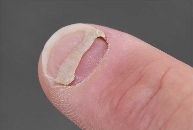 Fingernagel löst sich ab / Nagelablösung