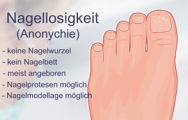 Nagellosigkeit / Anonychie - kein Nagelbett