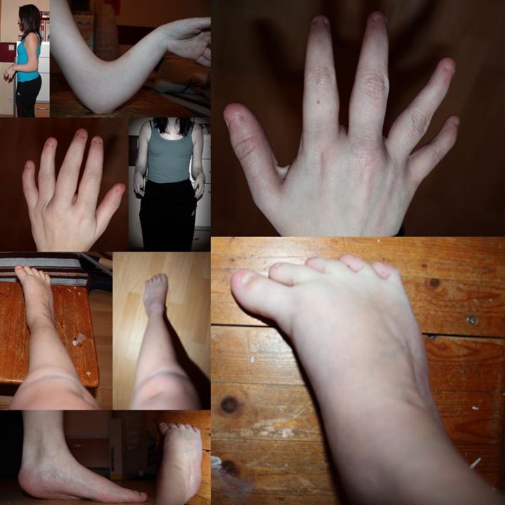 Nagel Patella Syndrom betroffene Hände und Füße